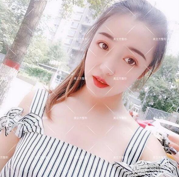 西安美立方雙眼皮怎么樣？真實(shí)案例圖片反饋~