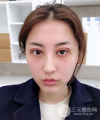 蘇州切開雙眼皮恢復(fù)果大分享，變化不止一點(diǎn)點(diǎn)