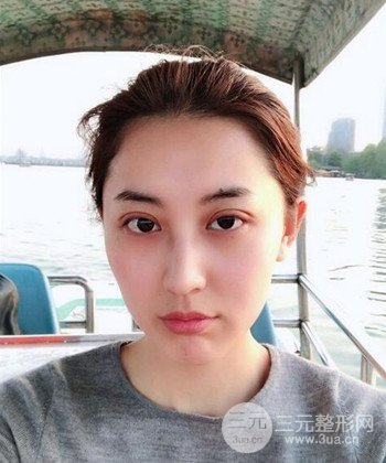 蘇州切開雙眼皮恢復(fù)果大分享，變化不止一點(diǎn)點(diǎn)