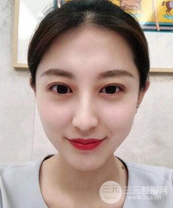 蘇州切開雙眼皮恢復(fù)果大分享，變化不止一點(diǎn)點(diǎn)
