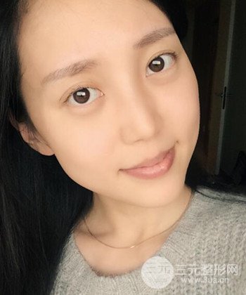 深圳內(nèi)切去眼袋+硅膠墊下巴真實(shí)案例恢復(fù)果圖