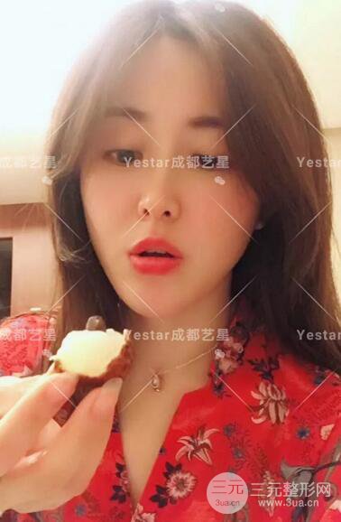 成都藝星蔡靈自體脂肪面部填充術(shù)后果記錄