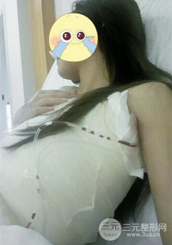 深圳假體隆胸讓平胸妹華麗變身，手術(shù)果分享