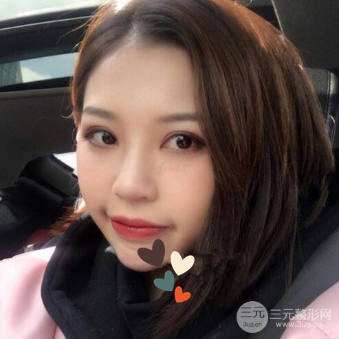 北京京民郭建玲割的雙眼皮案例術后一年果