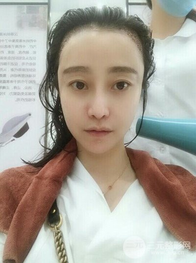 成都恒博發(fā)際線種植恢復過程分享