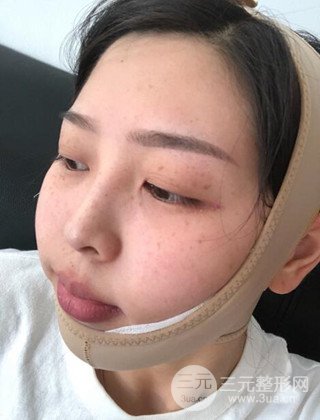 面部吸脂瘦臉手術(shù)日記分享，瘦臉果驚人