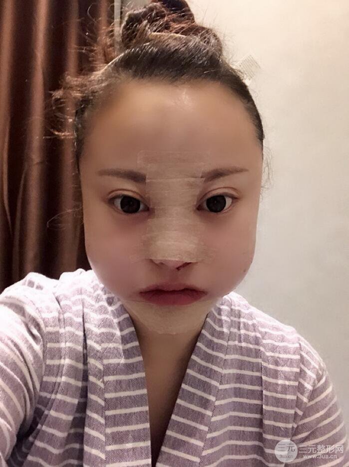 太原麗都面部吸脂+假體隆鼻案例分享，精致面部小V臉了解一下~