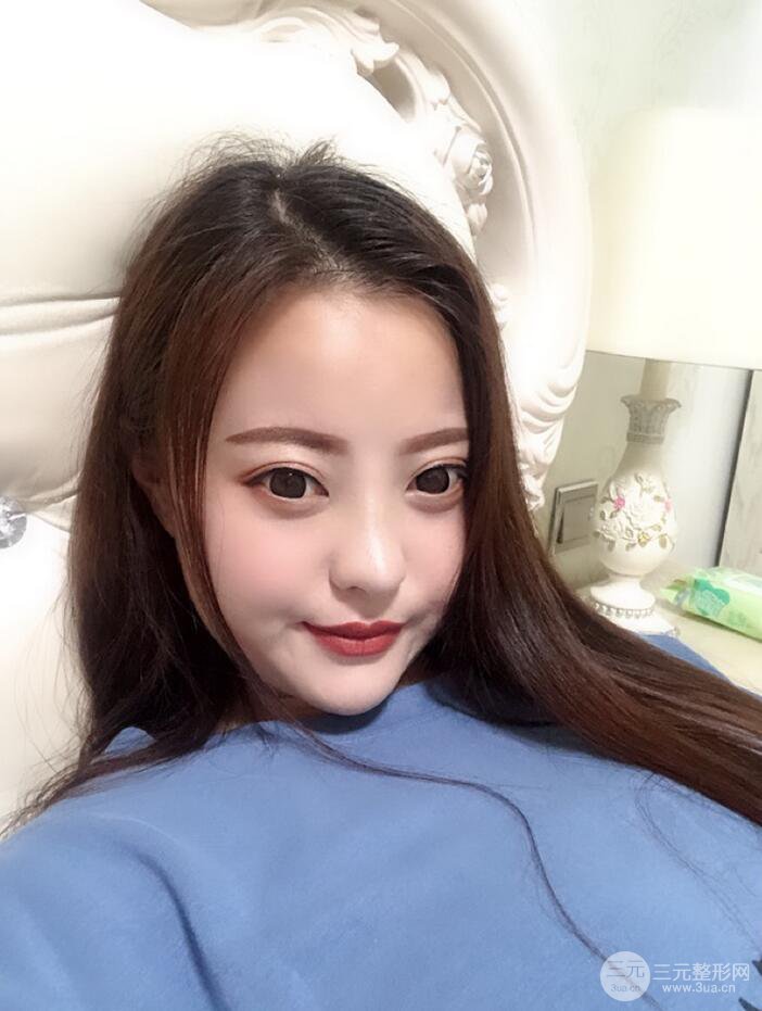 太原麗都面部吸脂+假體隆鼻案例分享，精致面部小V臉了解一下~