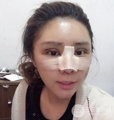 隆鼻整形+埋埋蛋白線.提升+自體脂肪全臉填充術(shù)后改頭換面！