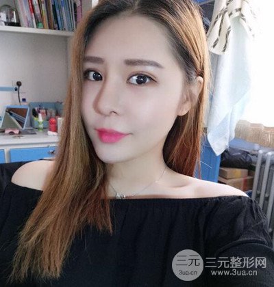 隆鼻整形+埋埋蛋白線.提升+自體脂肪全臉填充術(shù)后改頭換面！