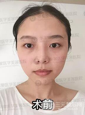 華美紫馨邱偉雙眼皮案例術(shù)后7天果圖分享