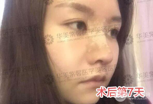 華美紫馨邱偉做的隆鼻術(shù)后10天驚人果分享！