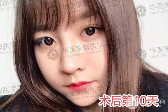 華美紫馨邱偉做的隆鼻術(shù)后10天驚人果分享！