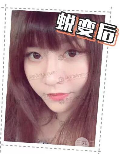 華美紫馨邱偉做的隆鼻術(shù)后10天驚人果分享！