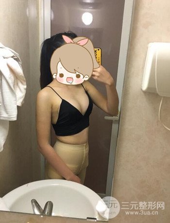 北京自體脂肪隆胸手術日記分享，豐胸術后恢復果圖