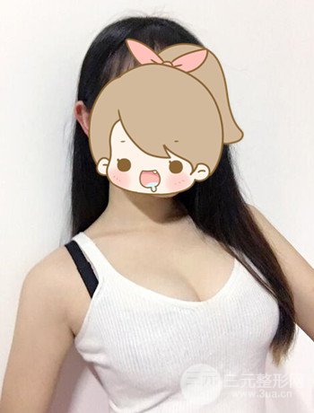 北京自體脂肪隆胸手術日記分享，豐胸術后恢復果圖