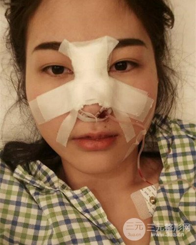 膨體隆鼻案例分享，四川華人醫(yī)療游曉波醫(yī)生做的!