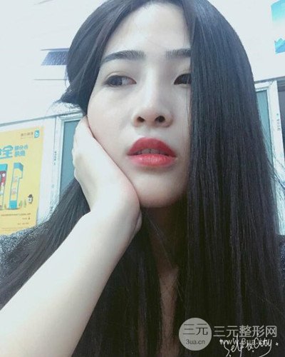 膨體隆鼻案例分享，四川華人醫(yī)療游曉波醫(yī)生做的!