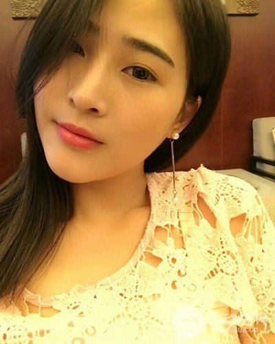 膨體隆鼻案例分享，四川華人醫(yī)療游曉波醫(yī)生做的!