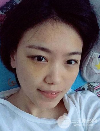 北京內(nèi)切祛眼袋真人案例果對比分享，年輕十歲不是夢