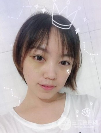北京內(nèi)切祛眼袋真人案例果對比分享，年輕十歲不是夢