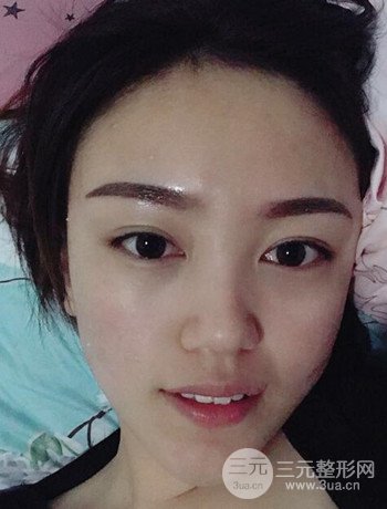 北京內(nèi)切祛眼袋真人案例果對比分享，年輕十歲不是夢