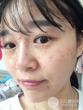 北京激光去雀斑真實案例分享，純素顏無濾鏡果圖