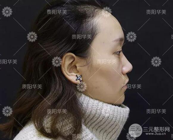 貴陽華美整形田永華雙眼皮+隆鼻+脂肪填充術后恢復日記