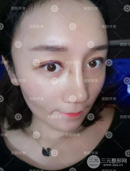 貴陽華美整形田永華雙眼皮+隆鼻+脂肪填充術后恢復日記