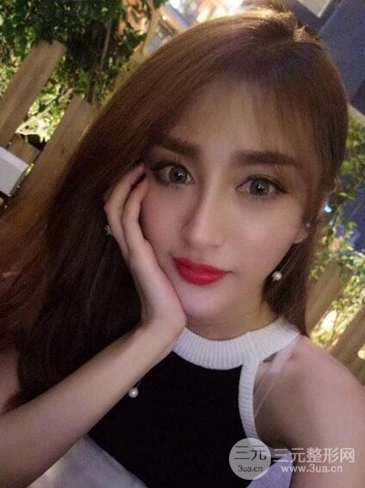 重慶鉑生王振榮隆鼻整形前后對比圖恢復(fù)過程分享