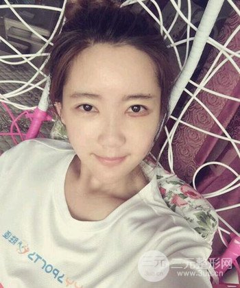 全臉自體脂肪填充手術(shù)日記分享，改良臉型年輕十歲