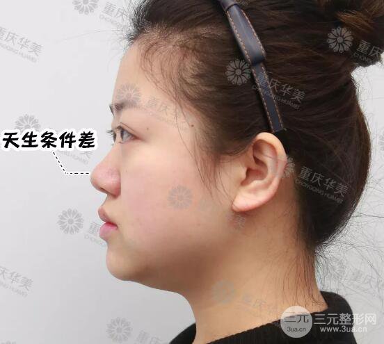 重慶華美潘寶華隆鼻案例合集一覽