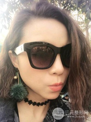 隆鼻整形手術真人案例恢復過程分享 附上果圖