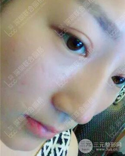 深圳聯(lián)合麗格線D隆鼻恢復日記以及前后對比圖分享！