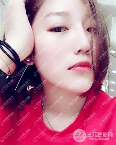 深圳聯(lián)合麗格線D隆鼻恢復日記以及前后對比圖分享！