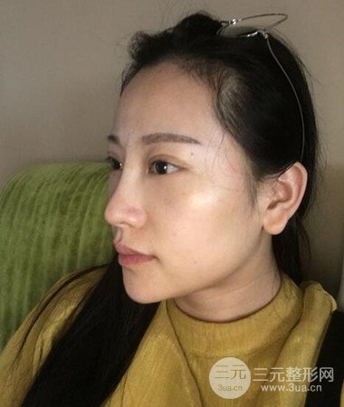 內(nèi)切微創(chuàng)去眼袋手術(shù)案例分享，附上手術(shù)恢復(fù)照片