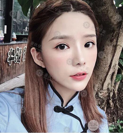 重慶萬州華美潘寶華雙眼皮+內眼角前后對比圖被贊氣質港風女神!