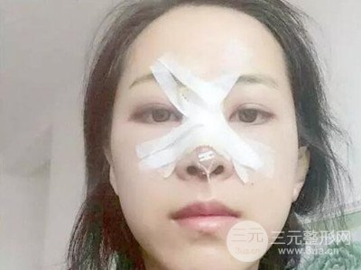 長(zhǎng)沙鵬愛彭正春假體隆鼻案例分享