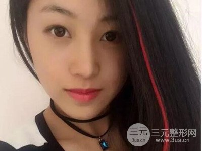 長(zhǎng)沙鵬愛彭正春假體隆鼻案例分享