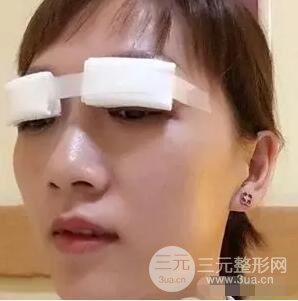 吉林銘醫(yī)李紅雙眼皮修復(fù)前后對(duì)比圖 內(nèi)附吉林銘醫(yī)小彩蛋哦