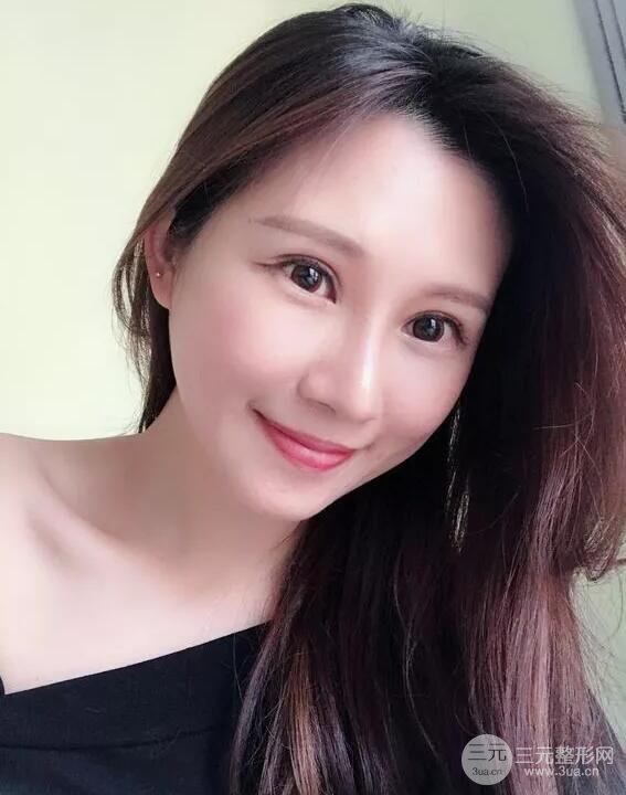 蘭大二院張選奮怎么樣?雙眼皮修復案例前后對比圖