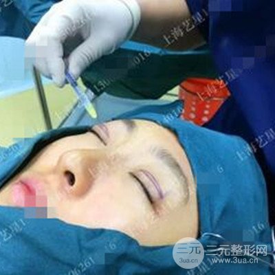 上海藝星雙眼皮日記分享，割雙眼皮后大變樣！