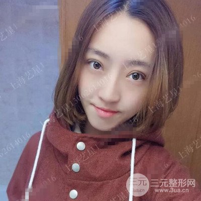 上海藝星雙眼皮日記分享，割雙眼皮后大變樣！