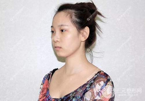 沈陽百嘉麗隆鼻整形案例前后對比圖分享~