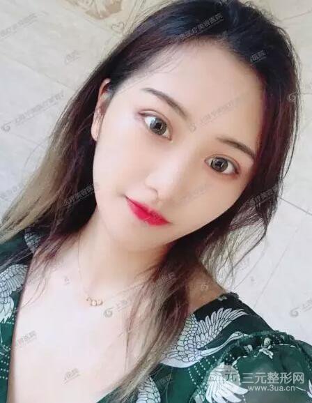 上海華美楊亞益全切雙眼皮案例對(duì)比圖 男女雙眼皮案例混搭