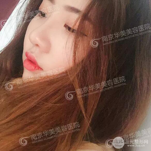 南京華美膨體隆鼻+耳軟骨墊鼻尖+鼻中隔矯正案例前后對(duì)比圖分享~