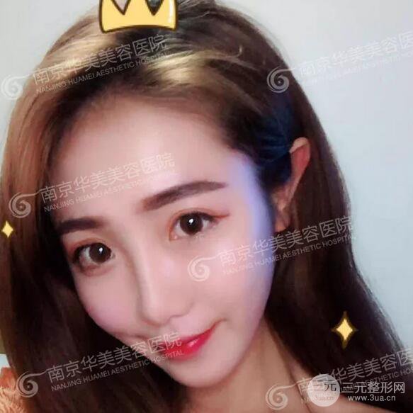 南京華美膨體隆鼻+耳軟骨墊鼻尖+鼻中隔矯正案例前后對(duì)比圖分享~