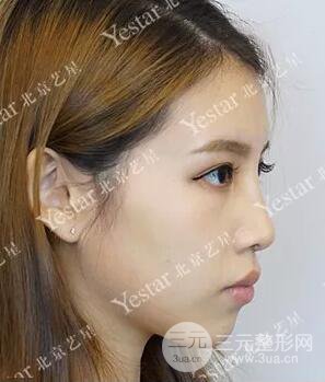 北京藝星仇侃敏耳軟骨隆鼻恢復(fù)過程|內(nèi)附前后對比圖