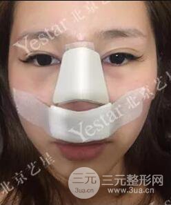 北京藝星仇侃敏耳軟骨隆鼻恢復(fù)過程|內(nèi)附前后對比圖