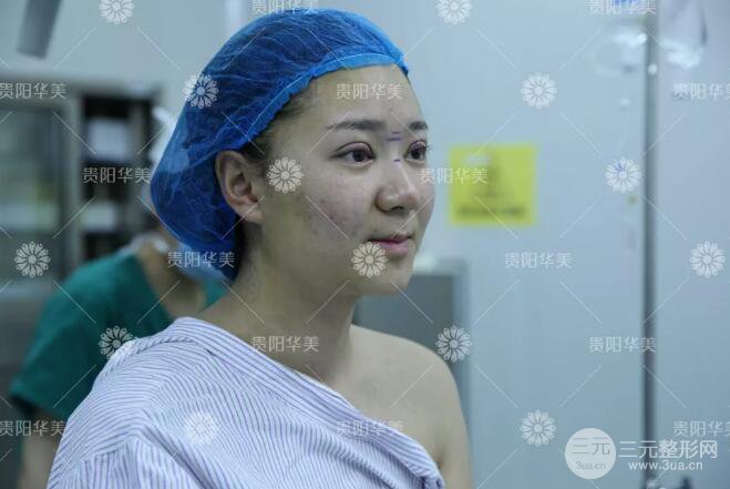 貴陽華美牛勇敢全切雙眼皮+假體隆鼻案例前后對比圖 華美員工全臉整形實錄
